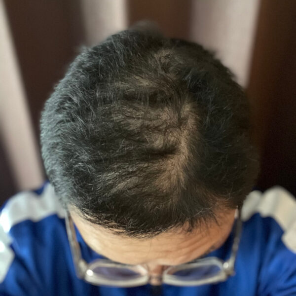 薄毛改善の検証実験開始より3ヶ月経過後　頭頂部状態　画像
