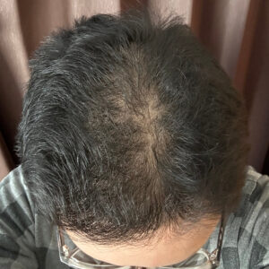 薄毛改善の検証実験開始より4ヶ月経過後　頭頂部状態　画像