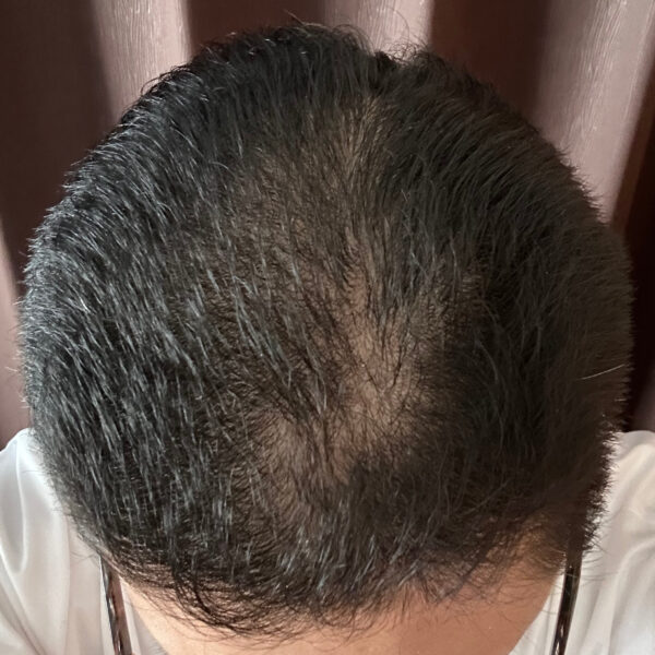 薄毛改善の検証実験開始より5ヶ月経過後　頭頂部状態　画像