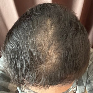 薄毛改善の検証実験開始より7ヶ月経過後　頭頂部状態　画像